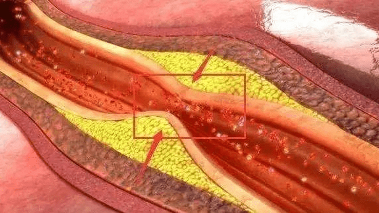 動(dòng)脈粥樣硬化斑塊能與大腦“對話”
